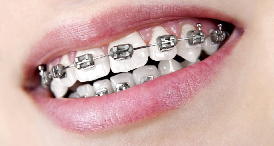 female mouth with braces